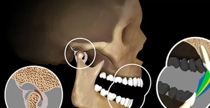 Temporomandibular Eklem Tedavileri