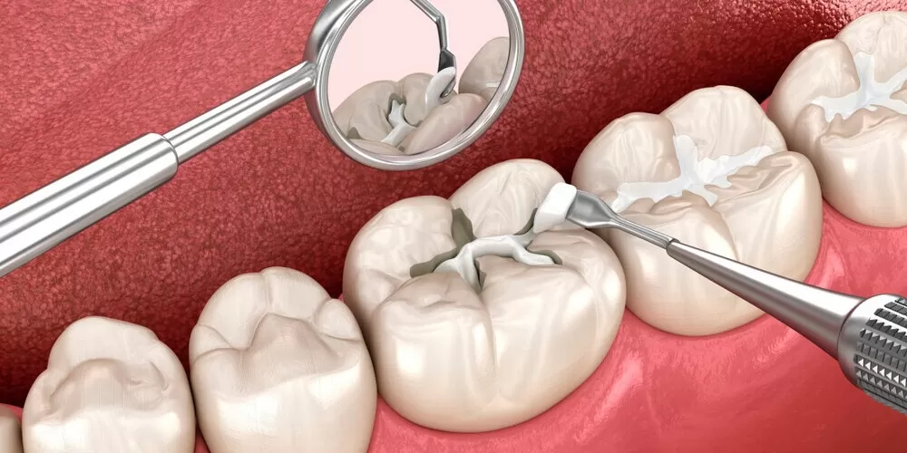 Fissür Örtücü Nedir? Diş Çürüklerini Engellemenin En Kolay Yolu