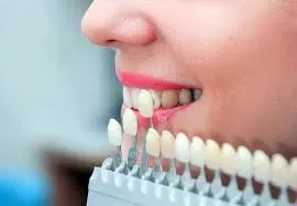 Laminalar İle Gülüş Tasarımı